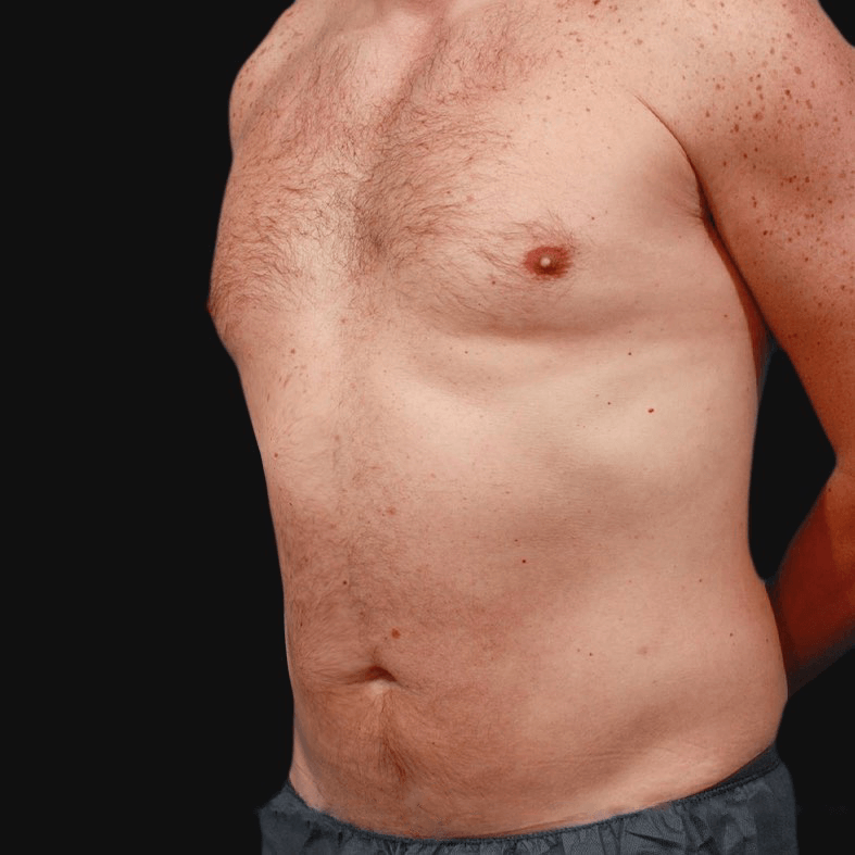 men liposuction before after Turkey