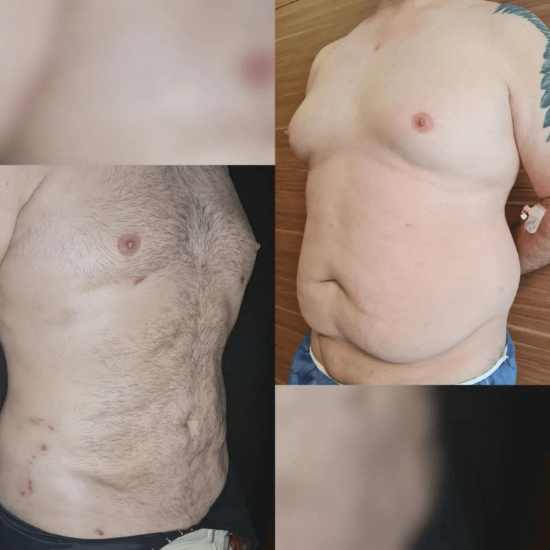 liposuction turkey before and after