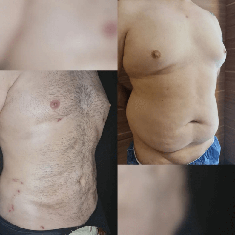 liposuction in Turkey before and after