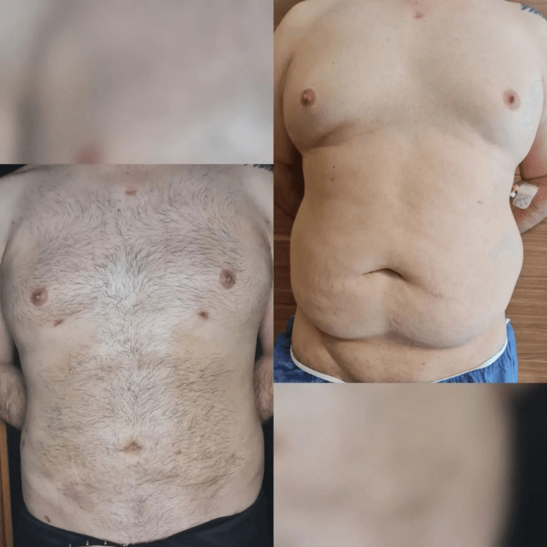 iposuction before and after Turkey