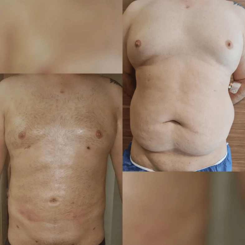 Liposuction before and after in Turkey