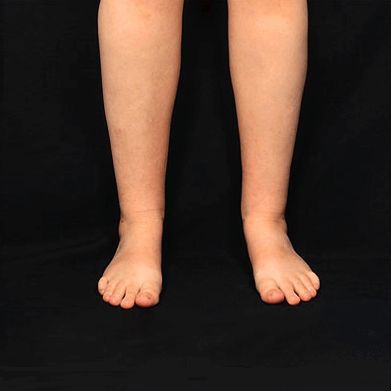 liposuction before and after legs in Turkey
