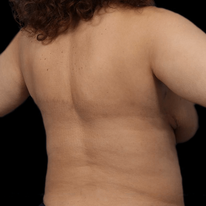 liposuction women before and after Turkey