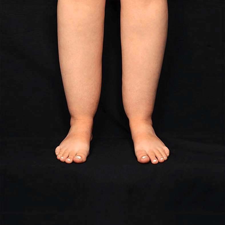 liposuction before and after legs