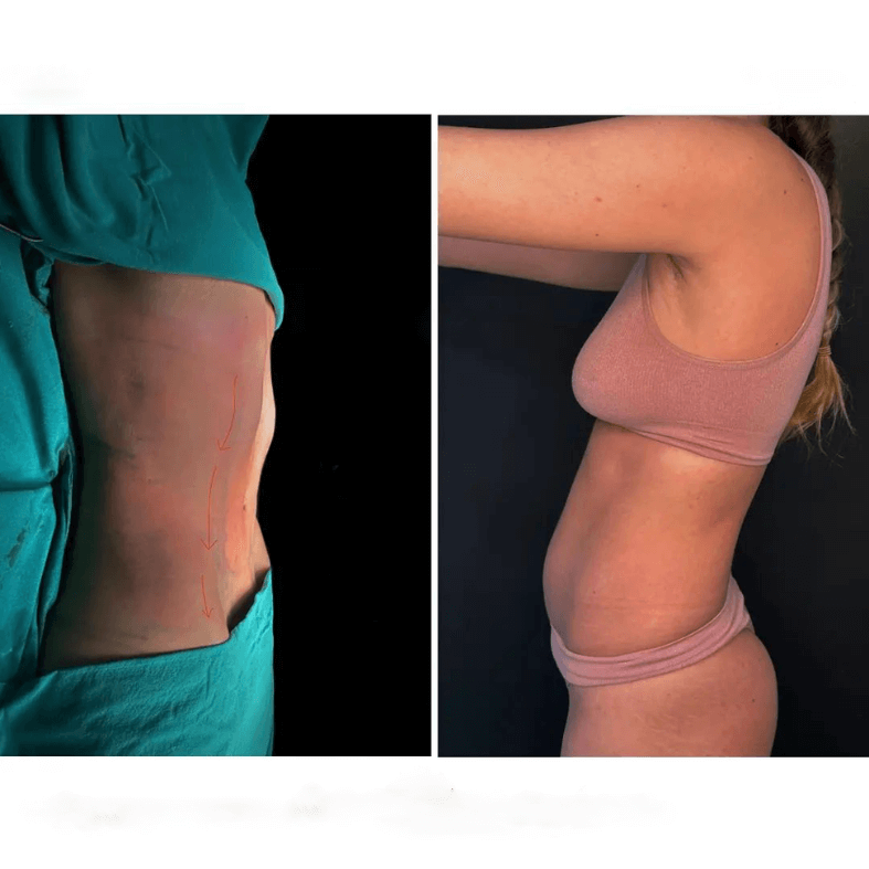 liposuction before and after women