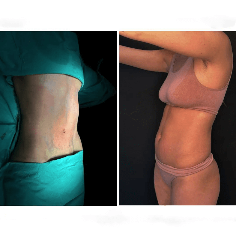 liposuction before and after women in Turkey