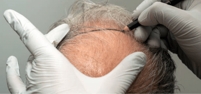 best-hair-transplant-surgeons-in-turkey