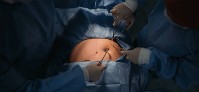 best-tummy-tuck-surgeons-in-turkey